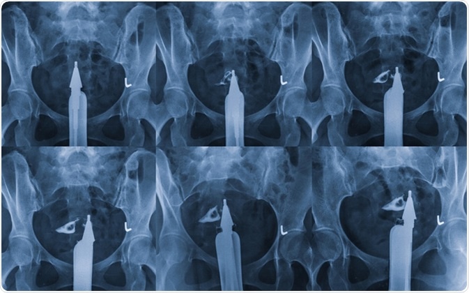 Hysterosalpingography is a type of X-ray called fluoroscopy that looks at a woman's uterus and fallopian tubes. Image Credit: MossStudio / Shutterstock